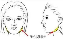 切骨瘦臉手術(shù)可能出現(xiàn)哪些并發(fā)癥？