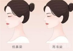 膨體隆鼻修復(fù)的佳時間
