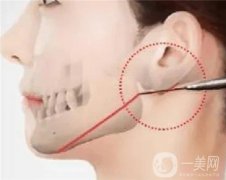 切骨手術(shù)的費用及疼痛程度