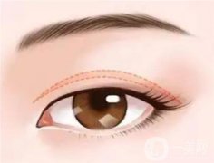 疤痕體質(zhì)是否適合割雙眼皮？