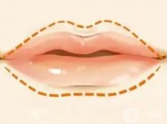 玻尿酸豐唇后嘴唇何時(shí)會變?nèi)彳洠?></a>
                            <div   id=