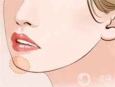 玻尿酸墊下巴有沒有后遺癥