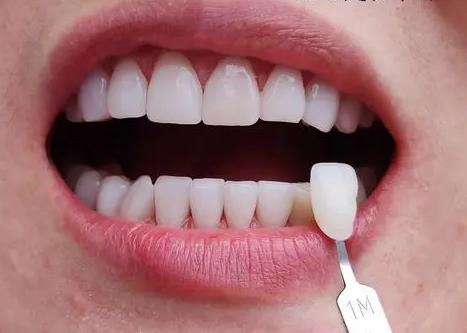 想要擁有耀眼笑容？不可錯過的金鈀合金烤瓷牙價格優(yōu)惠