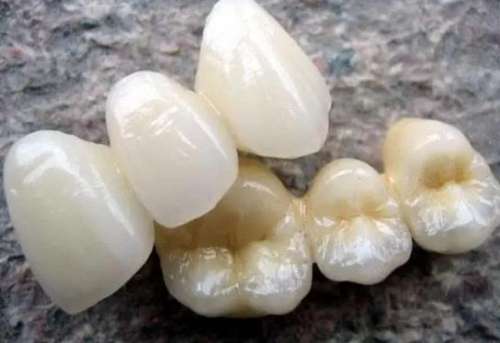 烤瓷牙套價(jià)格曝光：如何根據(jù)需求找到適合自己的價(jià)格？