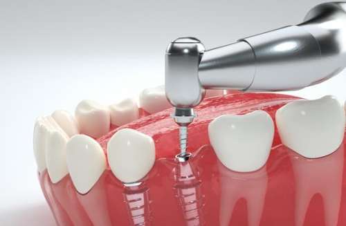 種植一顆牙需要多少錢？詳細(xì)解析牙齒修復(fù)費(fèi)用