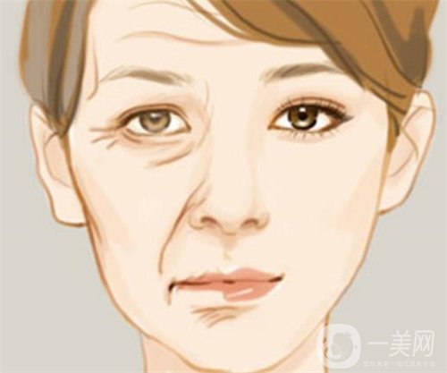 天津等離子除皺價格一般要多少