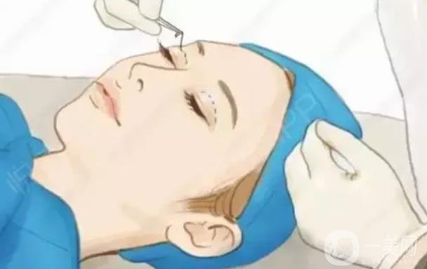 *開眼角貴嗎 價位大概是在多少